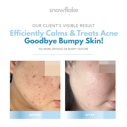 Acne Calming Cream